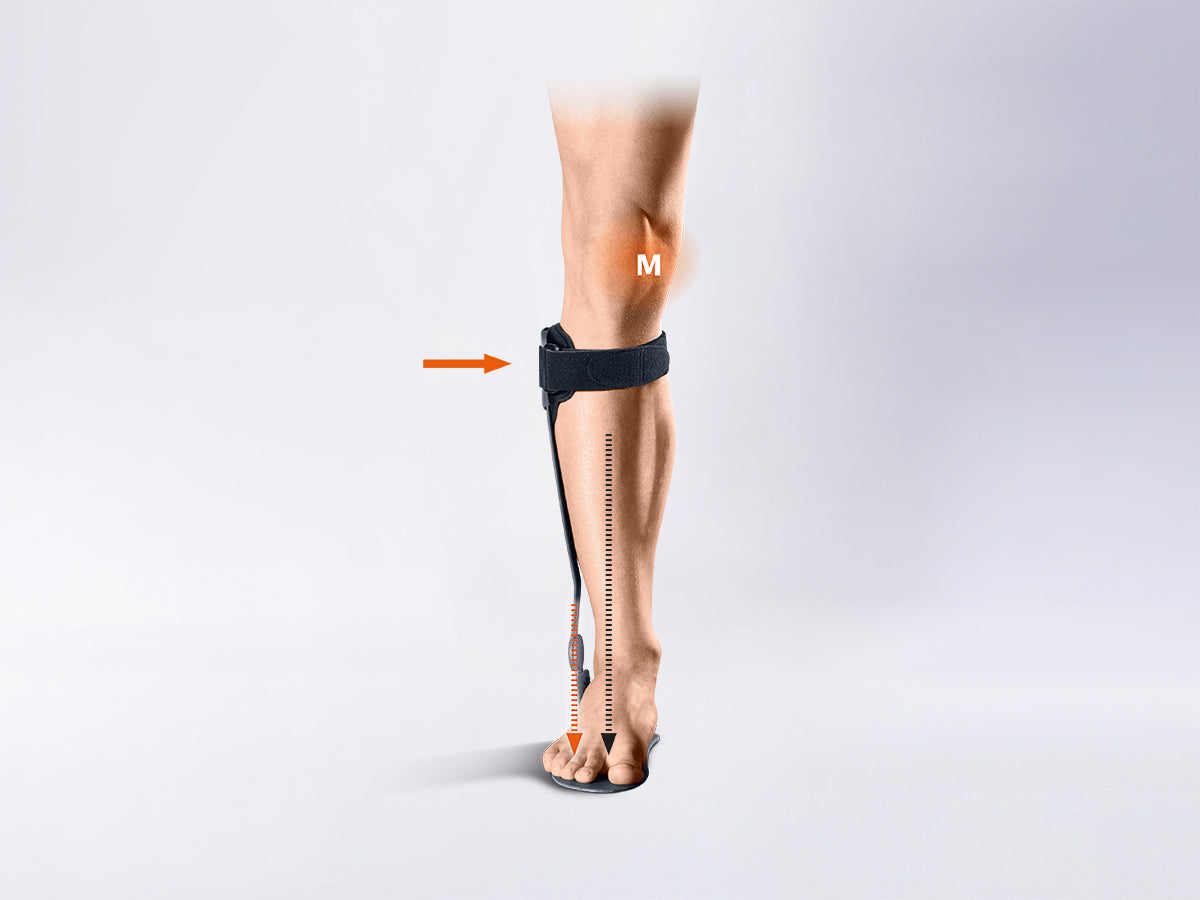 V-FORCE® Férula de alivio de rodilla (AO) para el compartimento medial o lateral en caso de artrosis femoro-tibial) de la rodilla (gonartrosis)