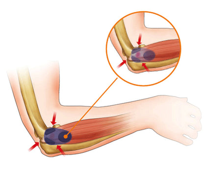 Bandage anti-épicondylite (vert)