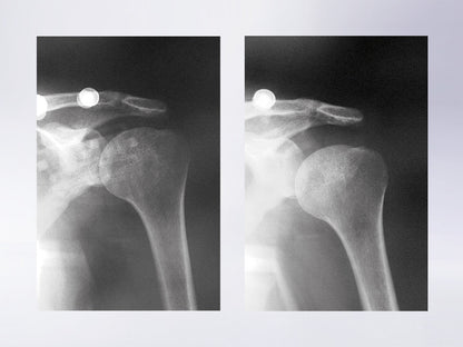 Orthèse de maintien de l'épaule et bras Neuro-Lux II après AVC par exemple